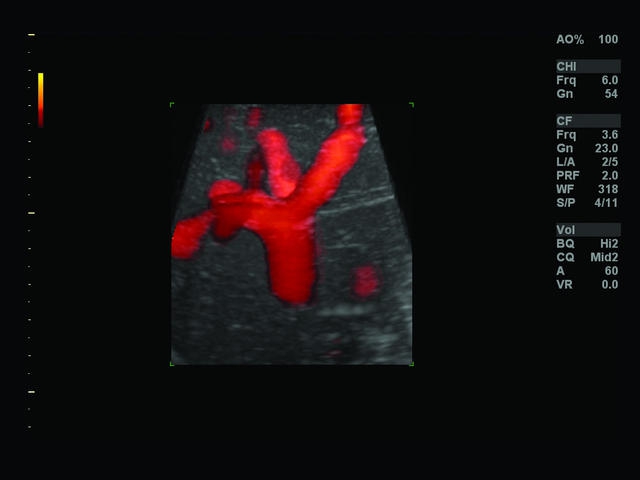 GE Logiq S7 с XDClear